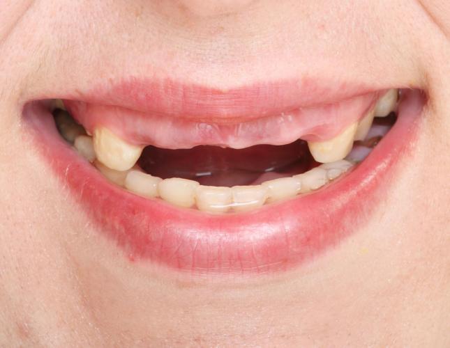 What Is the Full Impact of Missing Teeth?